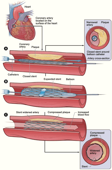 Schema dell'angioplastica coronarica con espansione dello stent